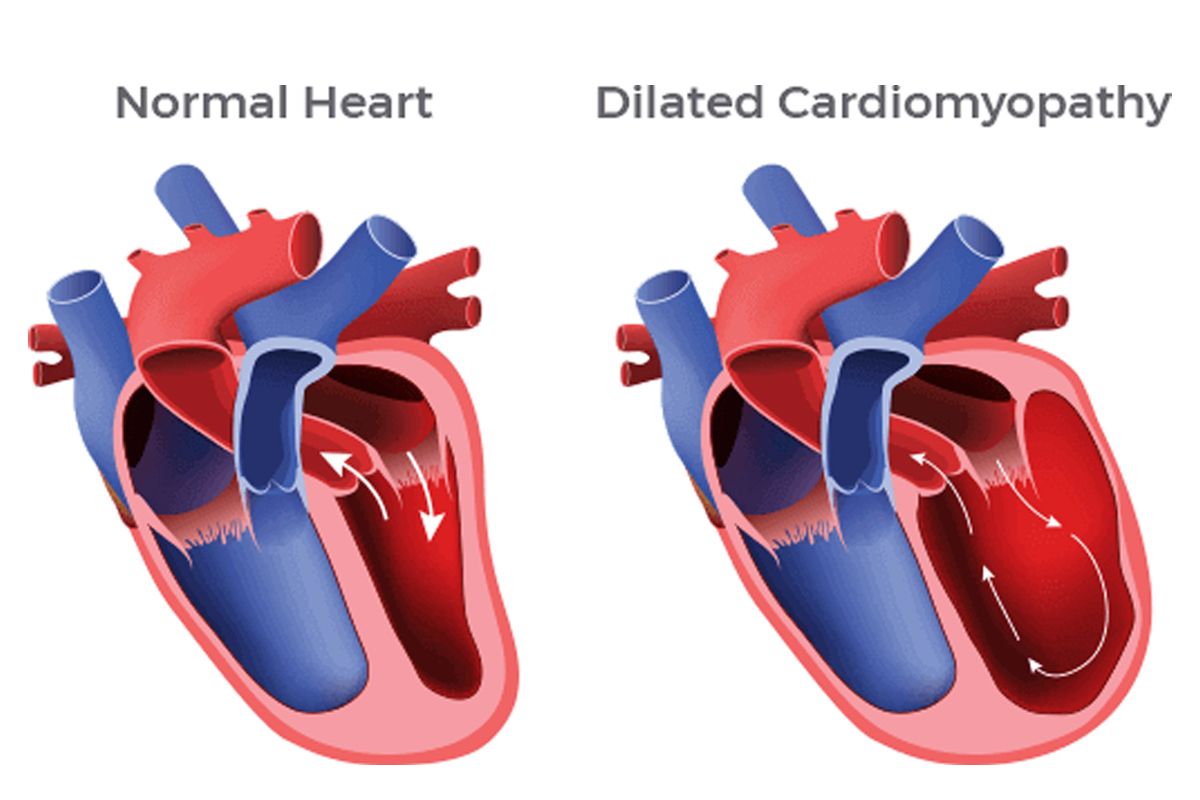 Best Cardiomyopathy Treatment in Pune