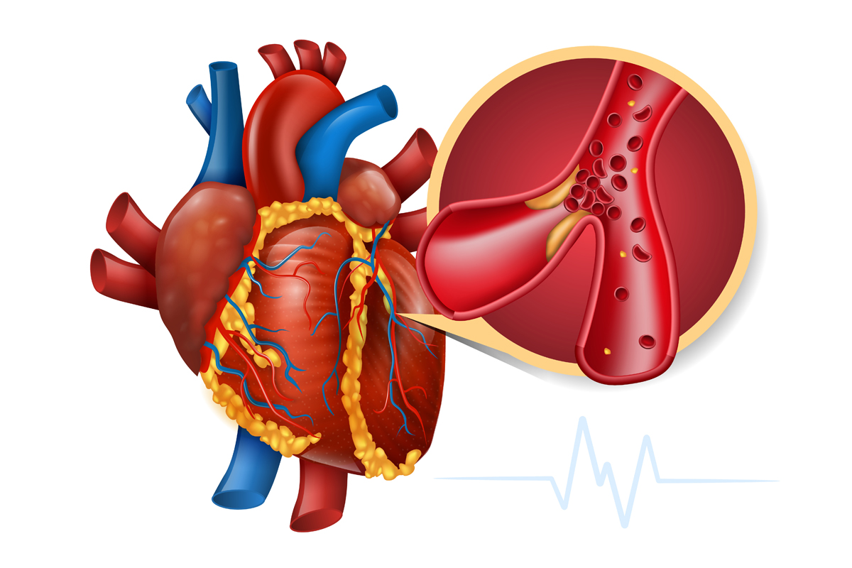 Myocardial Infarction Treatment in Baner, Pune