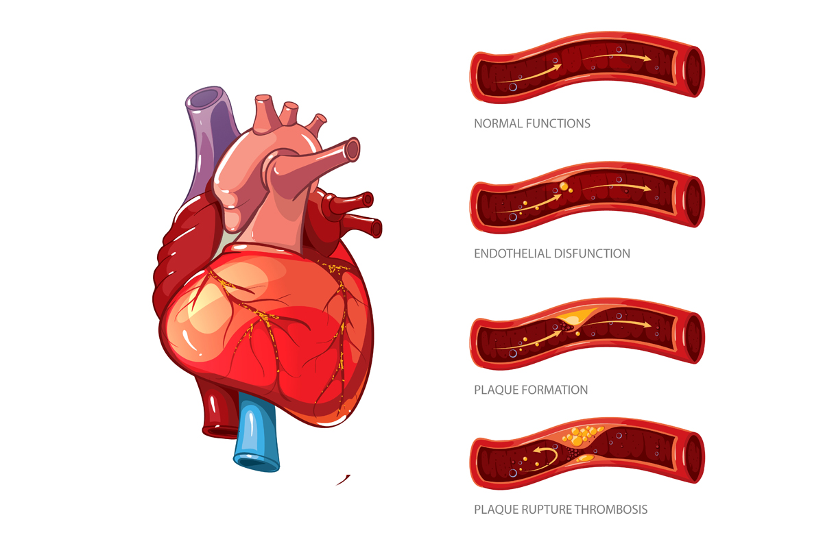 Best Coronary Angiography Treatment in Pune