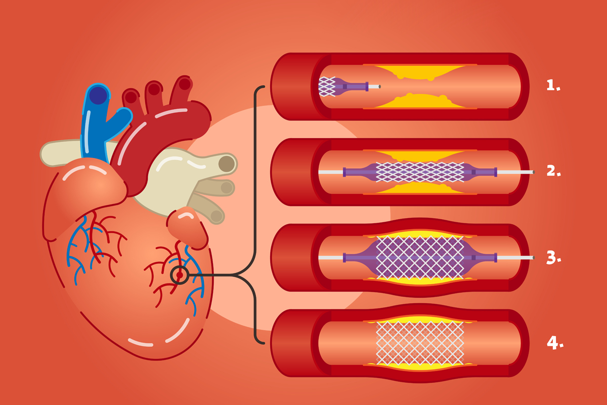 Best Coronary Artery Treatment in Pune