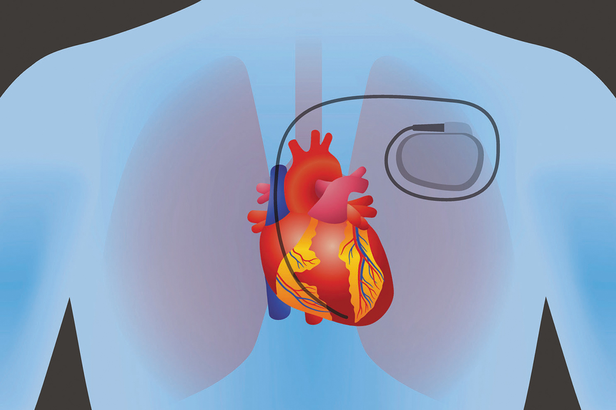 Pacemaker Surgery in Pune