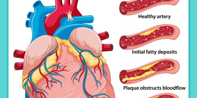 Coronary Artery Disease treatment in Pune