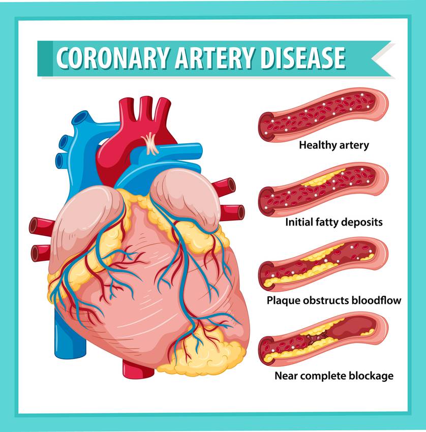 Coronary Artery Disease treatment in Pune